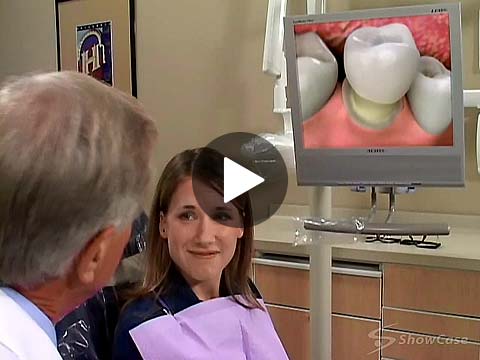 dental crowns video