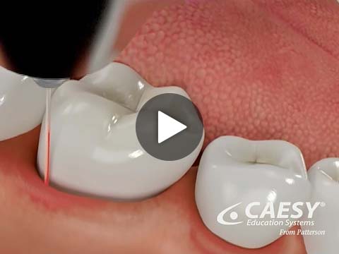 laser dentistry video